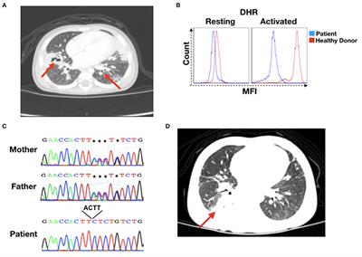 A Novel Mutation in the NCF2 Gene in a CGD Patient With Chronic Recurrent Pneumopathy